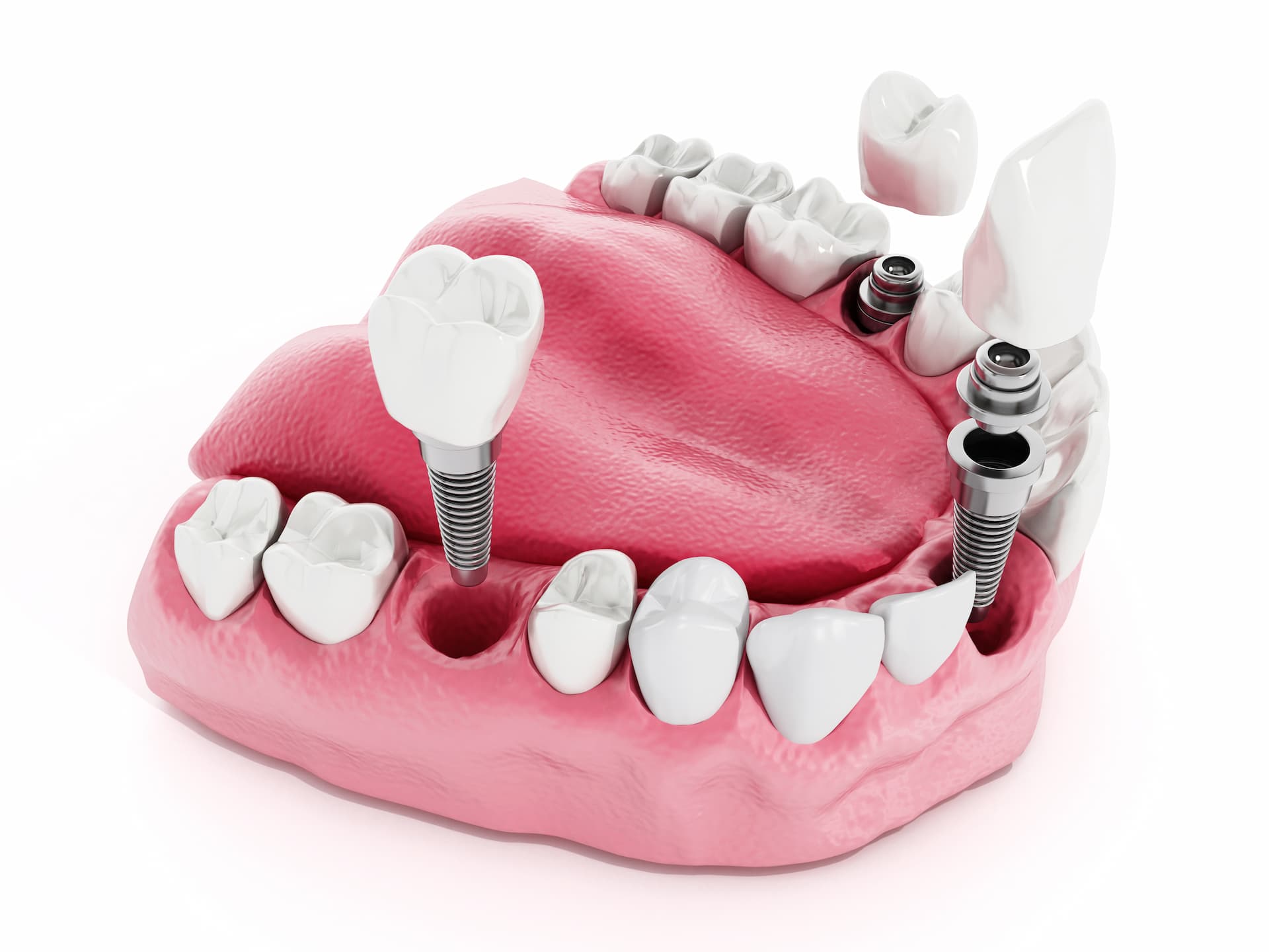 How Does a Tooth Implant Work? Ultimate Guide Hanna Dental Implant Center