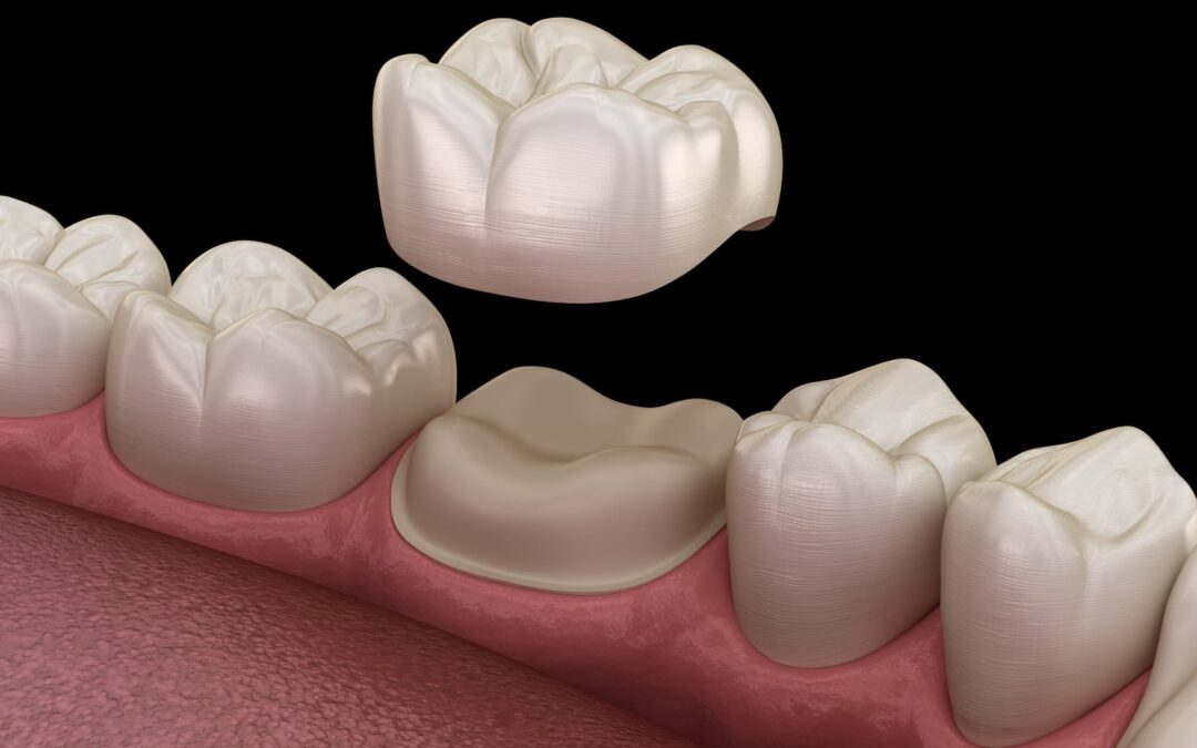 dental implant vs dental crown