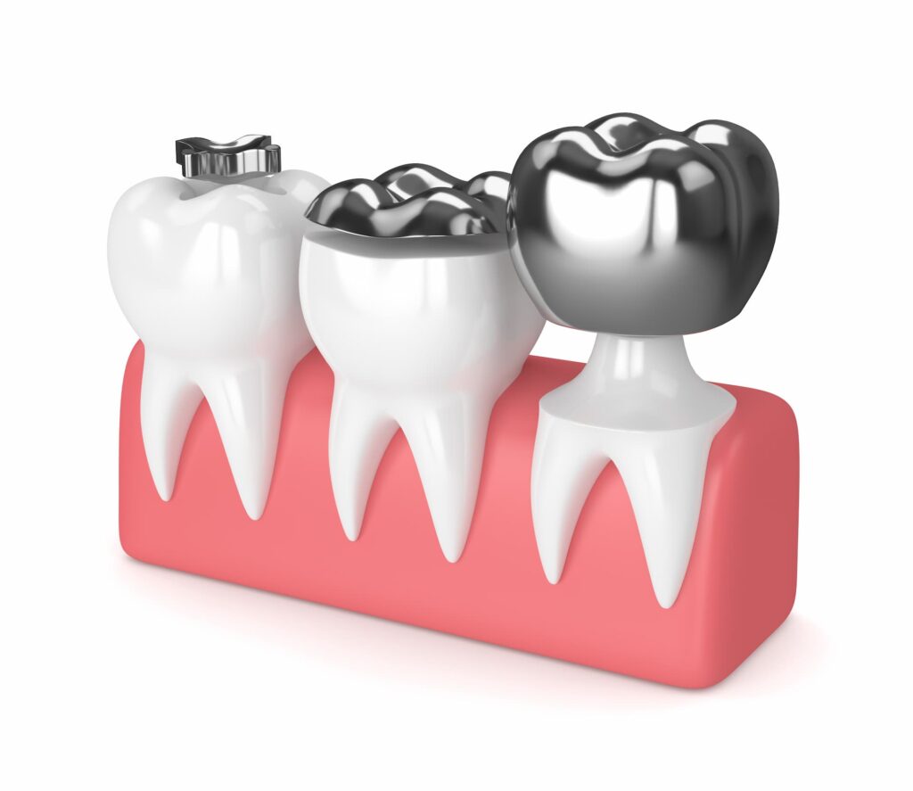 what is a dental crown