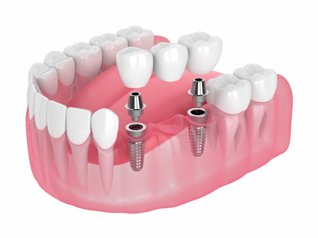 Bridges vs Dental Implant