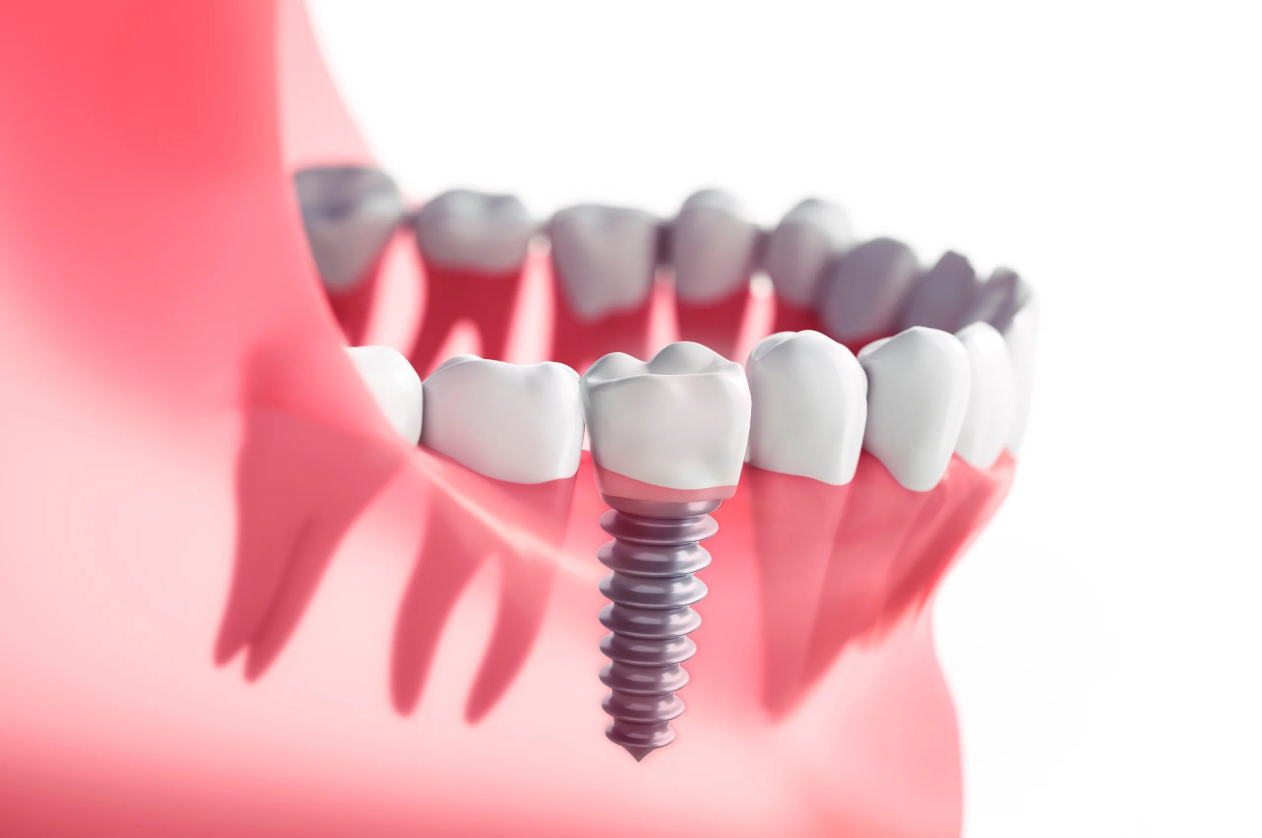 dental implant on jaw