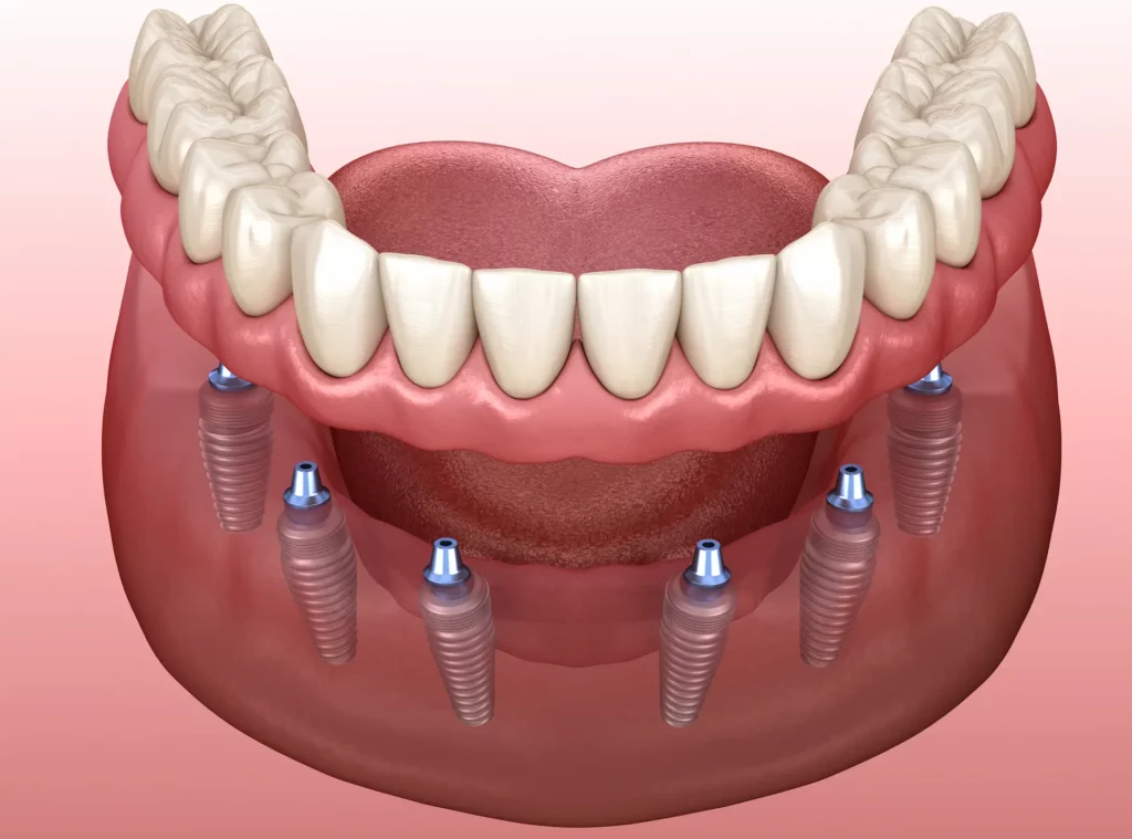 all on six dental implants