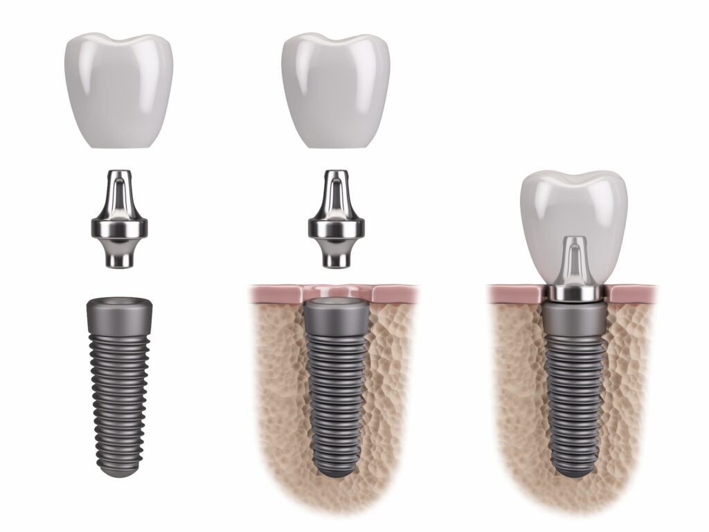 dental implant steps