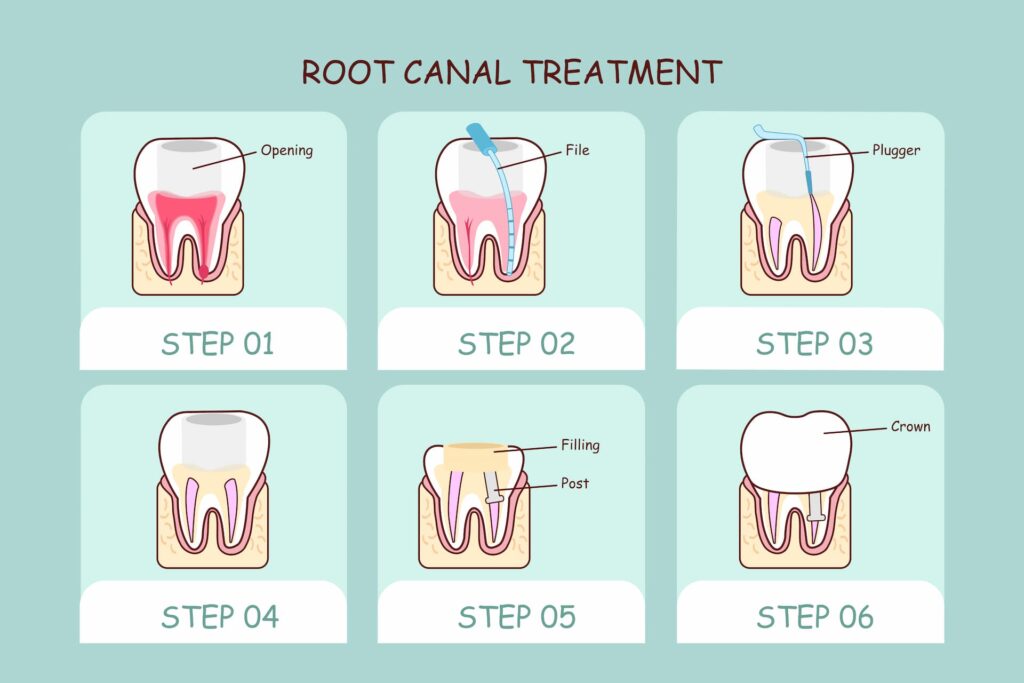 root canal steps