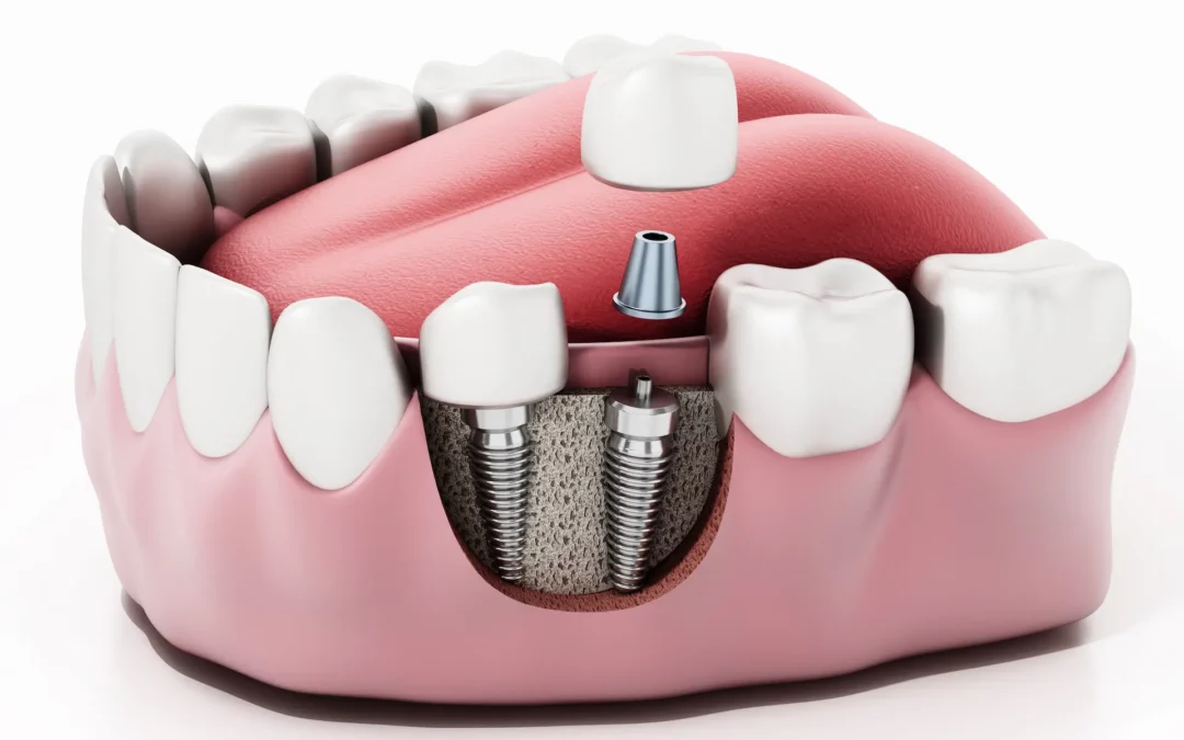 Multiple Teeth Implants: Procedure, Cost & Benefits | Expert Advice