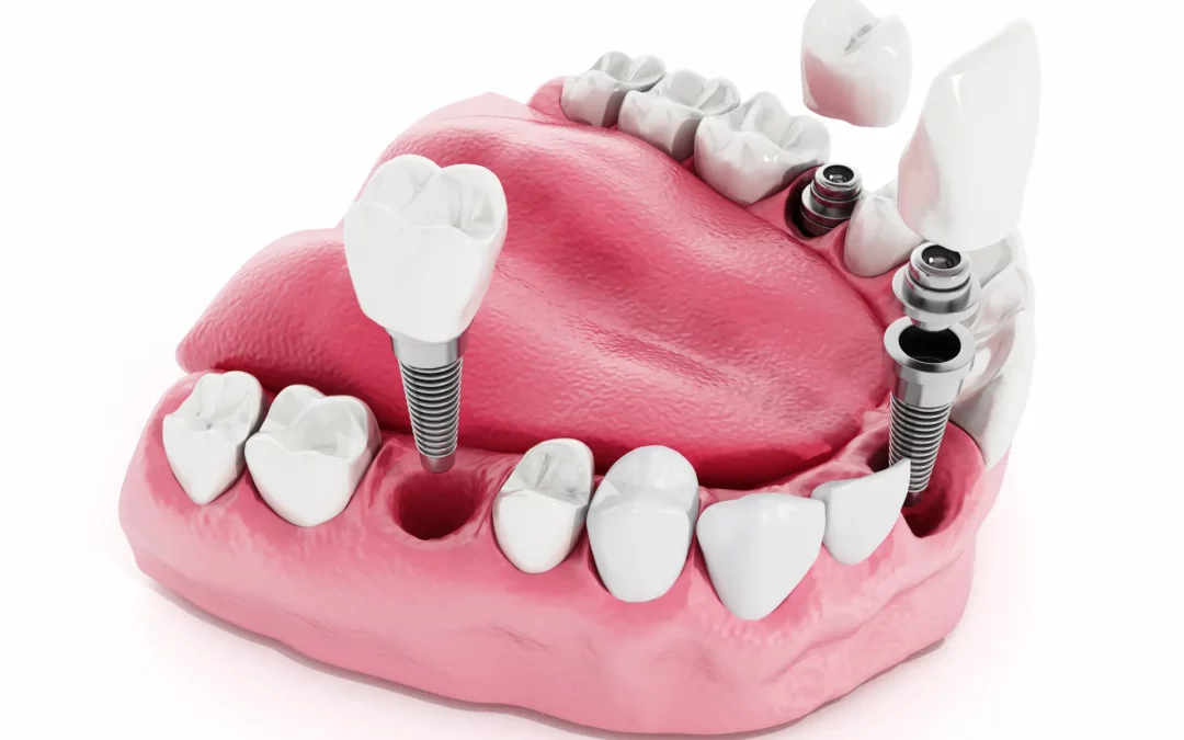 What Does a Dental Implant Look Like Complete Visual Guide Comparison
