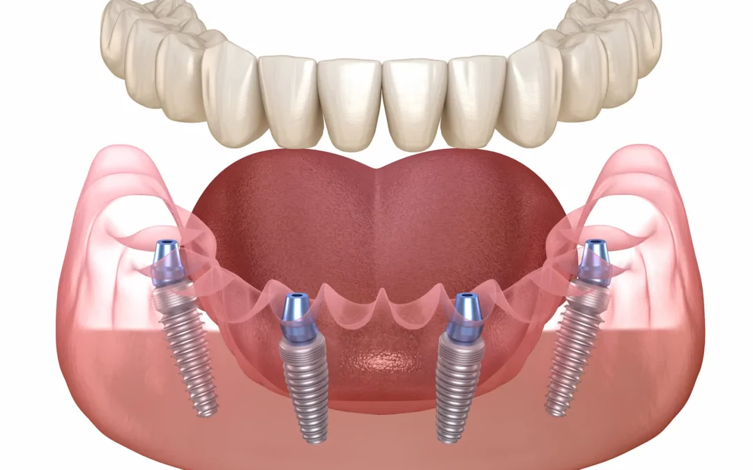 can you get dental implants with bone loss