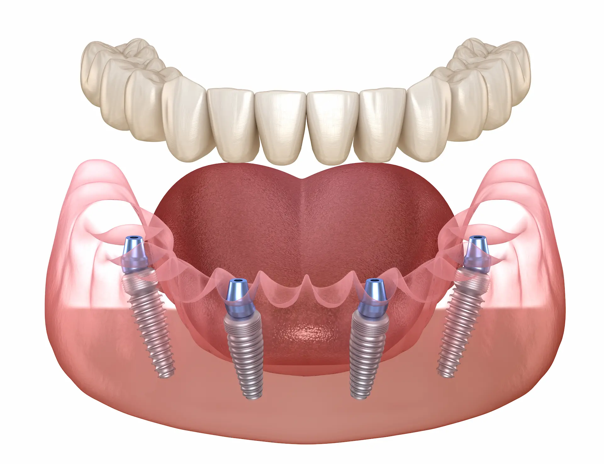 Dental Implants with Bone Loss Is It Possible? Hanna Dental Implant