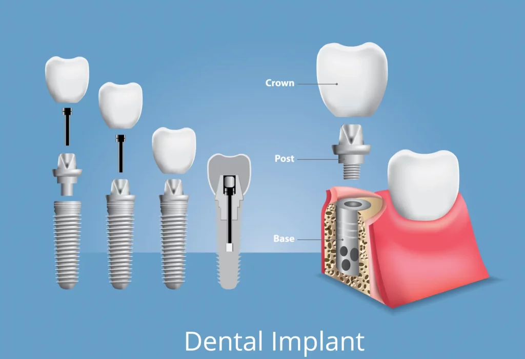 dental implant parts