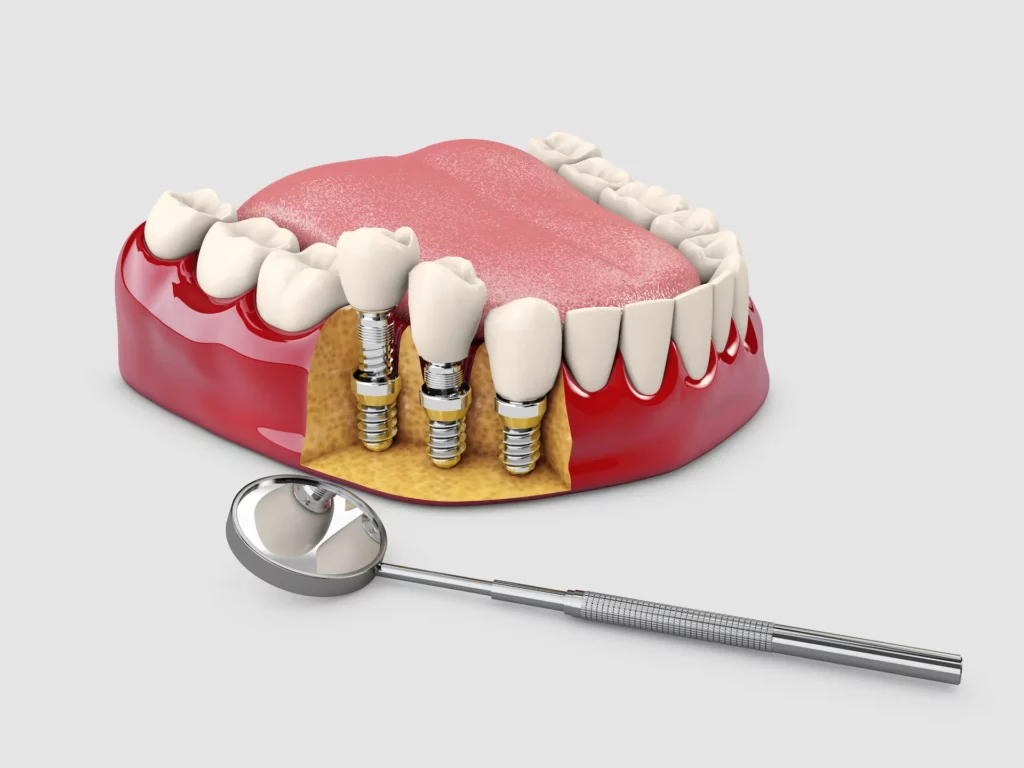 dental implants image
