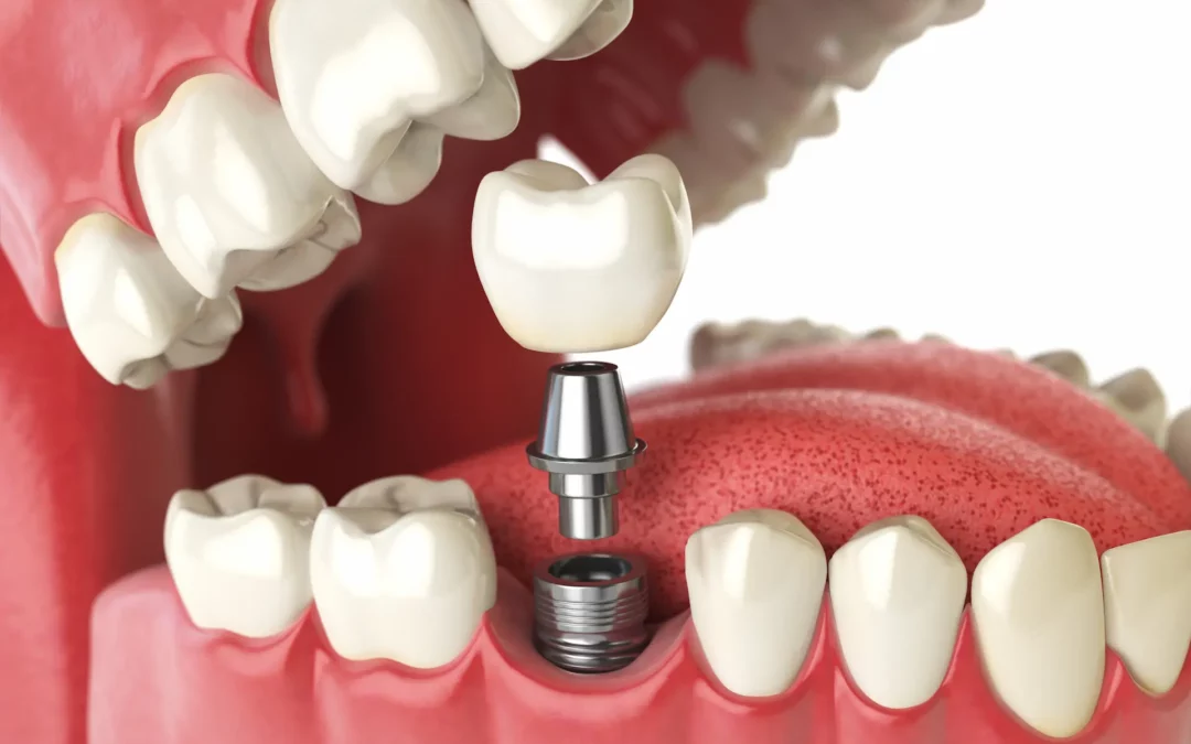How Much Bone Is Needed for a Dental Implant