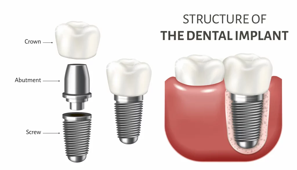 dental implant abutment