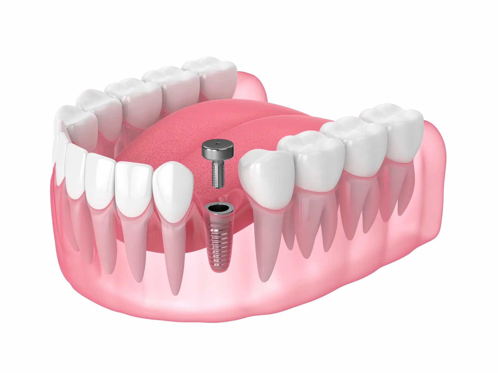thumbnail image 2 of 10x GDT Dental Healing Caps – 3.0mm Diameter Slim Platform – Titanium Int Hex 2.0mm (Israel) 2 of 2