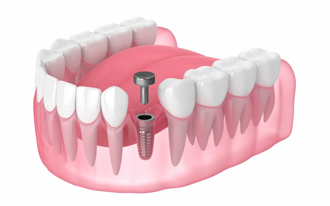 what are healing cap on dental implants