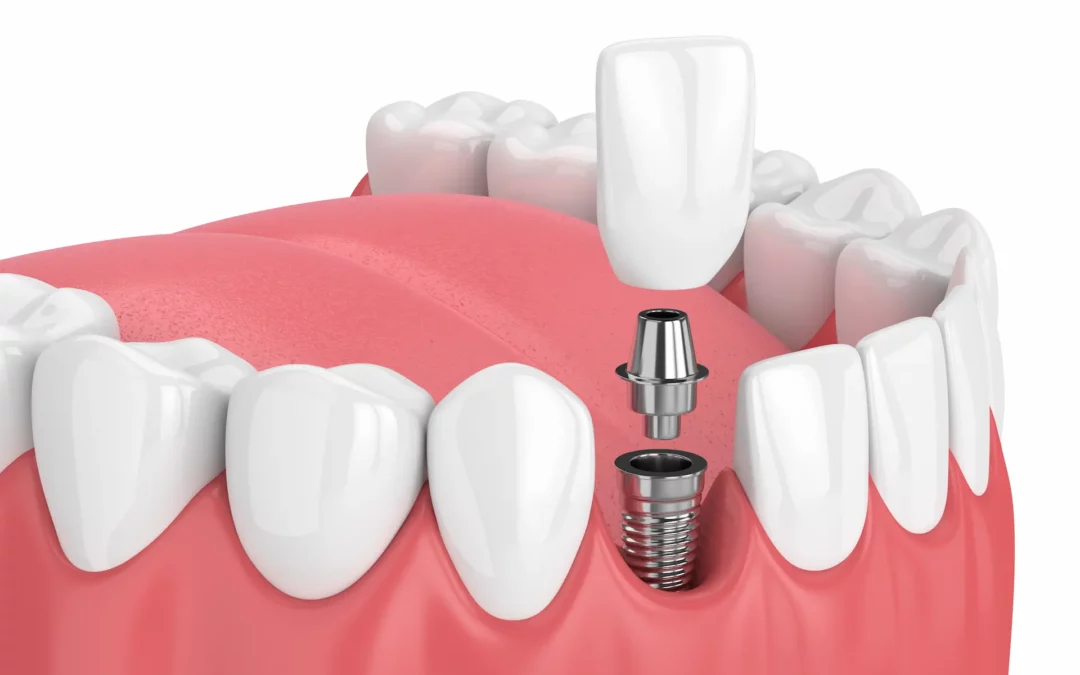 what is a dental implant abutment
