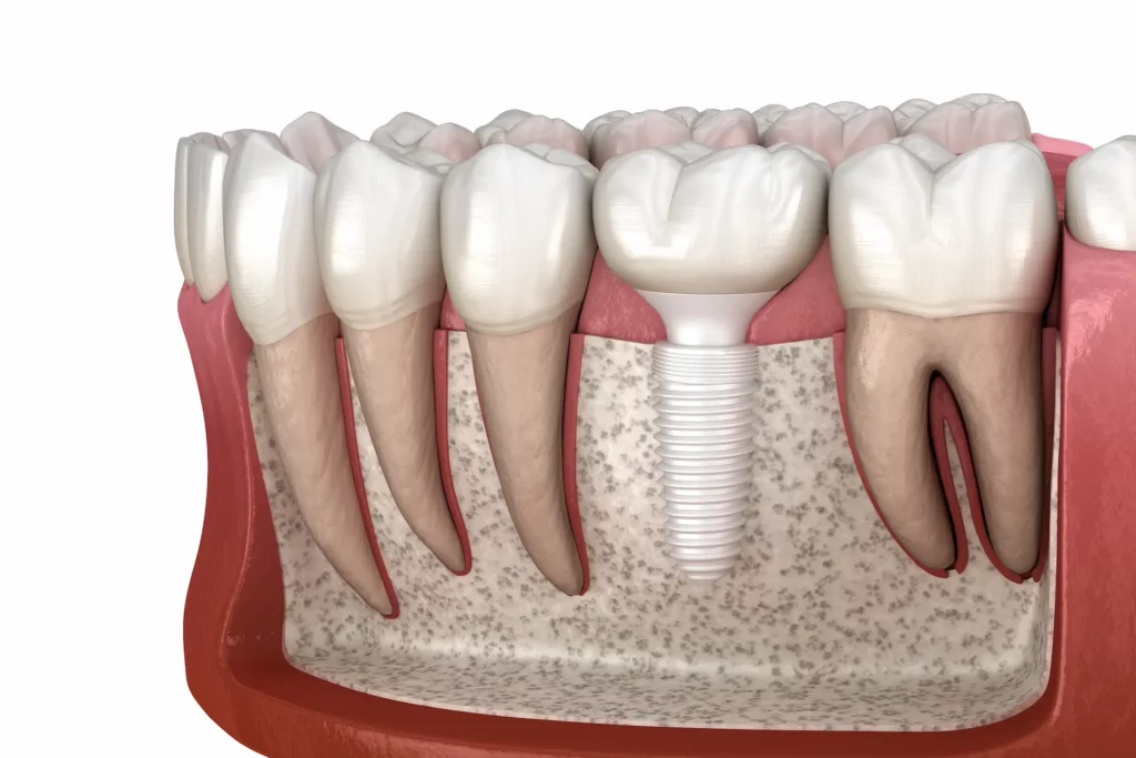 ceramic dental implant