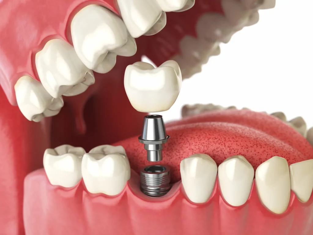 tintanium dental implant