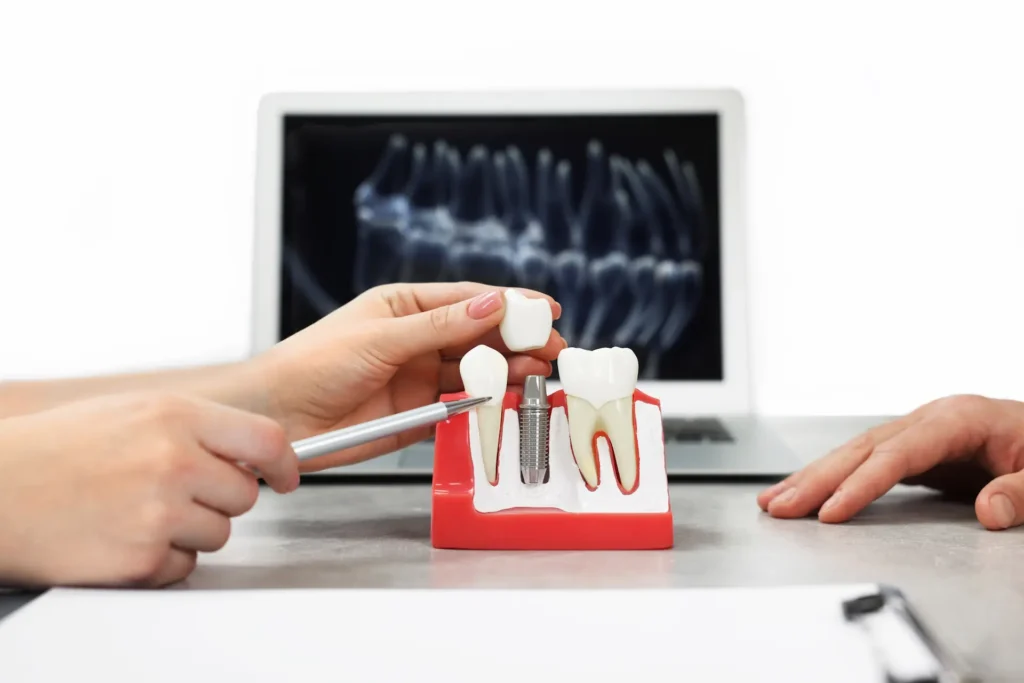 dental implants solution