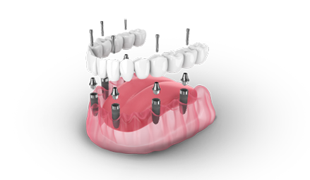All-On-Dental Implants