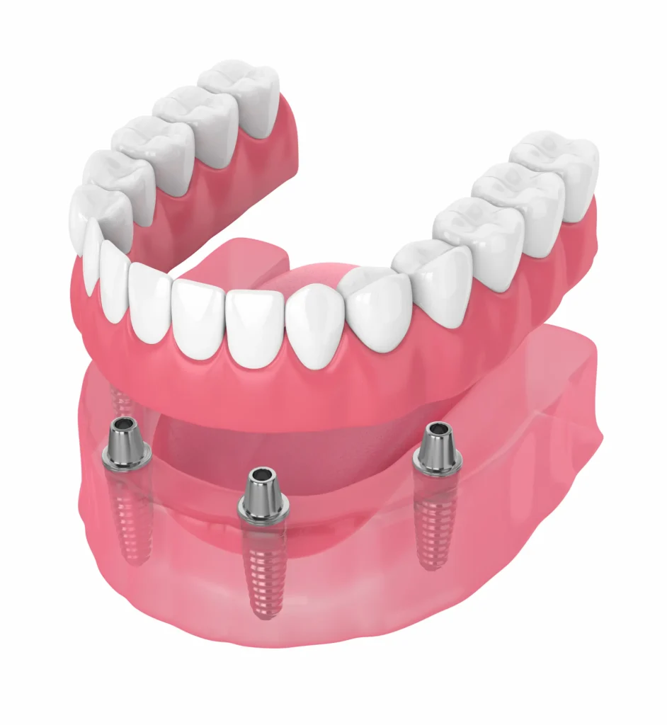 implant supported denture