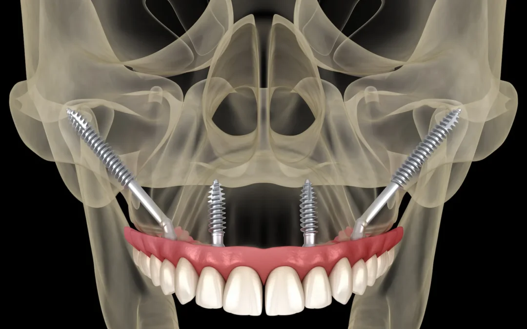 zygomatic dental implants in houston texas