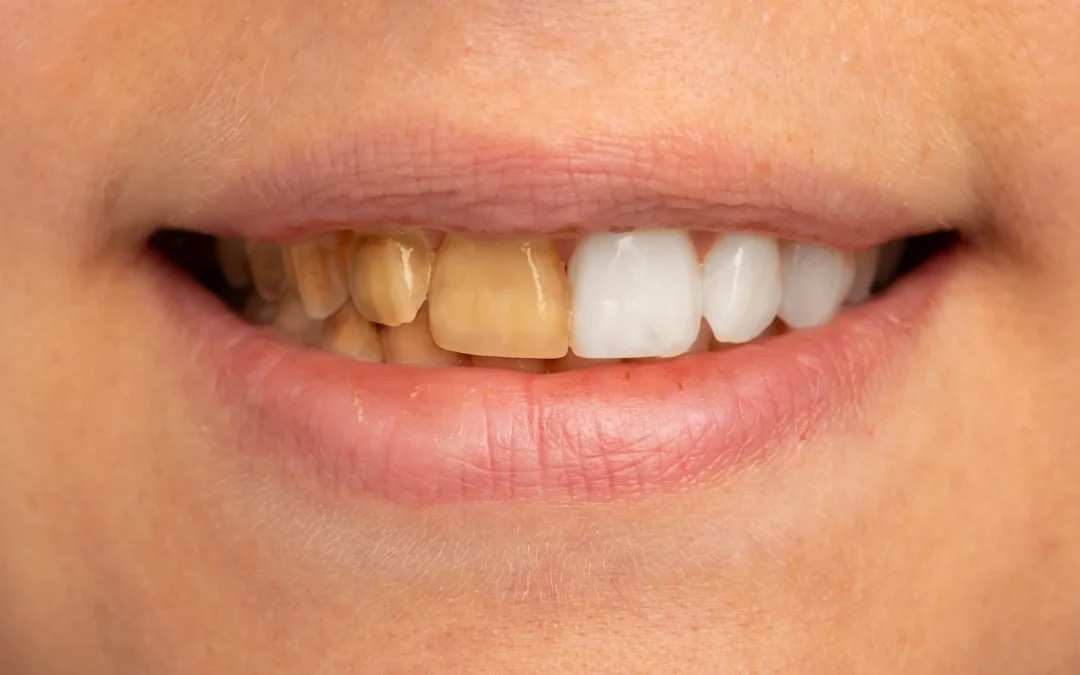 stained teeth causes, prevention, professional treatment options