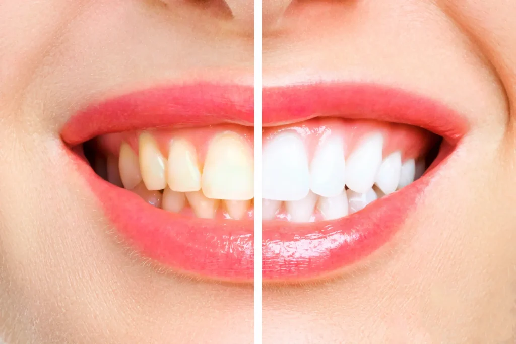 teeth whitening services in houston before and after