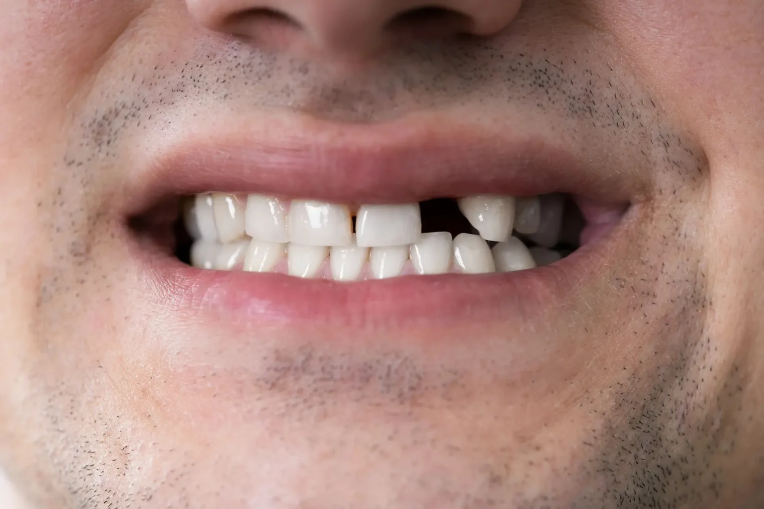 missing front tooth
