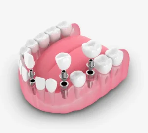 Dental Implant Bridges