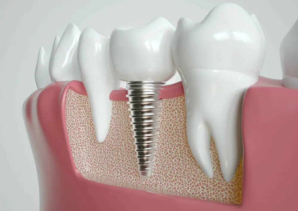 Dental Crown vs Implant